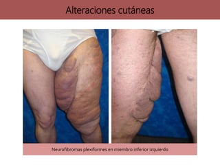 Neurofibromas plexiformes en miembro inferior izquierdo
Alteraciones cutáneas
 