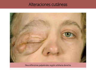 Neurofibromas palpebrales región orbitaria derecha
Alteraciones cutáneas
 