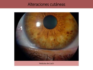 Alteraciones cutáneas
Nódulos de Lisch
 