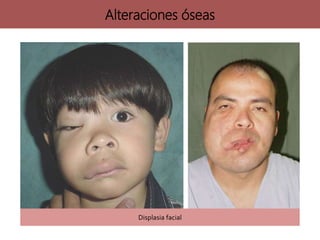Alteraciones óseas
Displasia facial
 