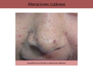 Angiofibromas faciales o adenomas sebáceos
Alteraciones cutáneas
 