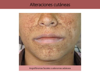 Angiofibromas faciales o adenomas sebáceos
Alteraciones cutáneas
 