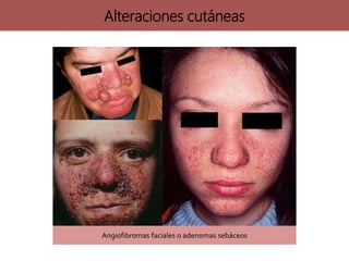 Angiofibromas faciales o adenomas sebáceos
Alteraciones cutáneas
 