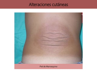 Alteraciones cutáneas
Piel de Marrasquino
 