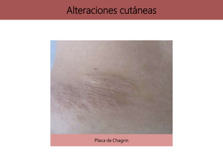 Alteraciones cutáneas
Placa de Chagrin
 
