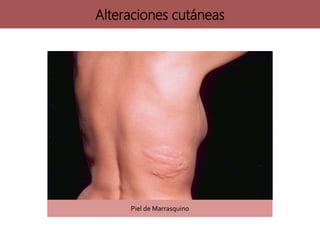 Piel de Marrasquino
Alteraciones cutáneas
 
