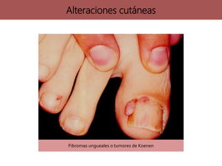 Fibromas ungueales o tumores de Koenen
Alteraciones cutáneas
 