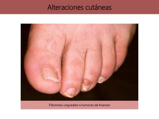 Fibromas ungueales o tumores de Koenen
Alteraciones cutáneas
 