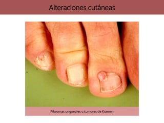 Fibromas ungueales o tumores de Koenen
Alteraciones cutáneas
 