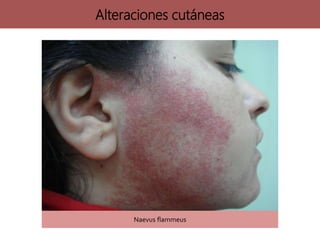 Naevus flammeus
Alteraciones cutáneas
 