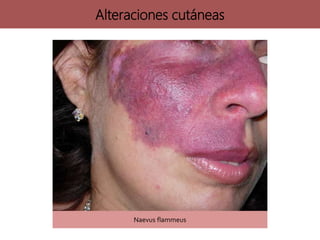 Naevus flammeus
Alteraciones cutáneas
 