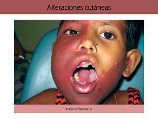 Naevus flammeus
Alteraciones cutáneas
 