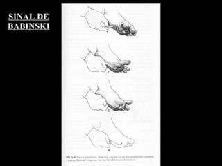 SINAL DE BABINSKI 