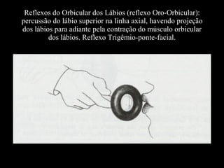Reflexos do Orbicular dos Lábios (reflexo Oro-Orbicular): percussão do lábio superior na linha axial, havendo projeção dos lábios para adiante pela contração do músculo orbicular dos lábios. Reflexo Trigêmio-ponte-facial. 