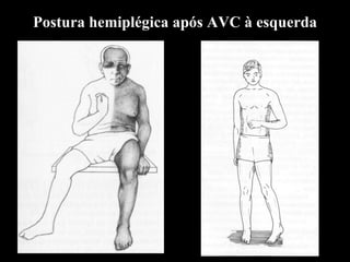 Postura hemiplégica após AVC à esquerda 