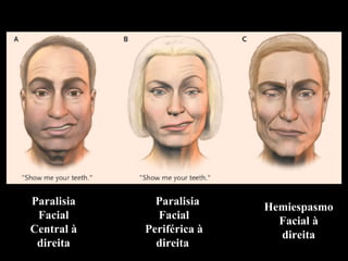 P Paralisia Facial Periférica à direita  Paralisia Facial Central à direita Hemiespasmo Facial à direita 