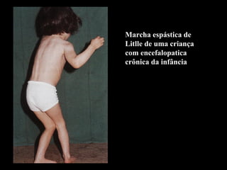 Marcha espástica de Litlle de uma criança com encefalopatica crônica da infância 