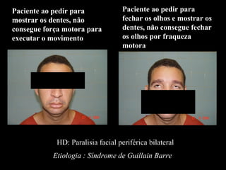 Paciente ao pedir para mostrar os dentes, não consegue força motora para executar o movimento Paciente ao pedir para fechar os olhos e mostrar os dentes, não consegue fechar os olhos por fraqueza motora HD: Paralisia facial periférica bilateral Etiologia : Síndrome de Guillain Barre 