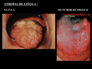 ATROFIA DE LINGUA  : NA E.L.A   NO TUMOR DE TRONCO 