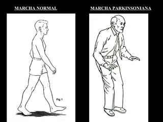 MARCHA NORMAL   MARCHA PARKINSONIANA 