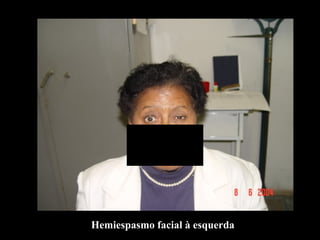 Hemiespasmo facial à esquerda 