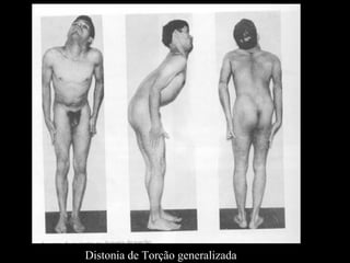 d Distonia de Torção generalizada 