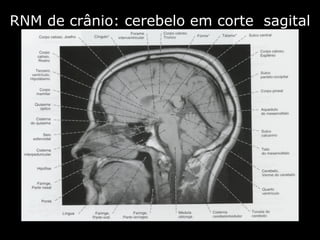RNM de crânio: cerebelo em corte  sagital 