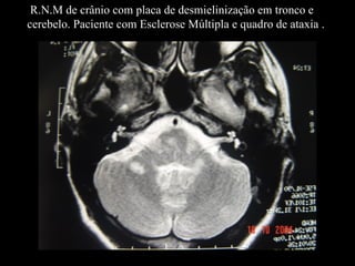 R.N.M de crânio com placa de desmielinização em tronco e cerebelo. Paciente com Esclerose Múltipla e quadro de ataxia . 