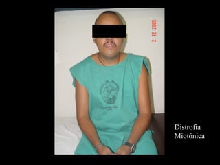 Distrofia Miotônica 