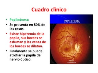 Cuadro clìnico
• Papiledema:
• Se presenta en 80% de
  los casos.
• Existe hiperemia de la
  papila, sus bordes se
  esfuman y las venas de
  los bordes se dilatan.
• Finalmente se puede
  atrofiar la papila del
  nervio òptico.
 