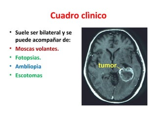 Cuadro clìnico
• Suele ser bilateral y se
  puede acompañar de:
• Moscas volantes.
• Fotopsias.
• Ambliopìa
• Escotomas
 
