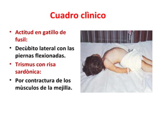 Cuadro clìnico
• Actitud en gatillo de
  fusil:
• Decùbito lateral con las
  piernas flexionadas.
• Trismus con risa
  sardònica:
• Por contractura de los
  mùsculos de la mejilla.
 