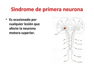 Sìndrome de primera neurona
• Es ocasionado por
  cualquier lesiòn que
  afecte la neurona
  motora superior.
 