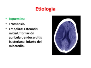 Etiologìa
• Isquemias:
• Trombosis.
• Embolias: Estenosis
  mitral, fibrilaciòn
  auricular, endocarditis
  bacteriana, infarto del
  miocardio.
 