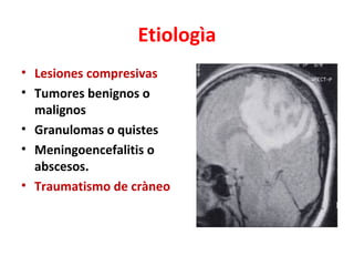 Etiologìa
• Lesiones compresivas
• Tumores benignos o
  malignos
• Granulomas o quistes
• Meningoencefalitis o
  abscesos.
• Traumatismo de cràneo
 