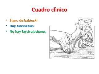 Cuadro clìnico
• Signo de babinski
• Hay sincinesias
• No hay fasciculaciones
 