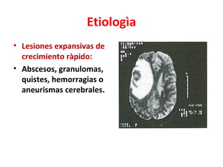 Etiologìa
• Lesiones expansivas de
  crecimiento ràpido:
• Abscesos, granulomas,
  quistes, hemorragias o
  aneurismas cerebrales.
 