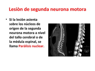 Lesiòn de segunda neurona motora
• Si la lesiòn asienta
  sobre los nùcleos de
  origen de la segunda
  neurona motora a nivel
  del tallo cerebral o de
  la mèdula espinal, se
  llama Paràlisis nuclear.
 