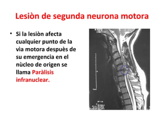 Lesiòn de segunda neurona motora
• Si la lesiòn afecta
  cualquier punto de la
  vìa motora despuès de
  su emergencia en el
  nùcleo de origen se
  llama Paràlisis
  infranuclear.
 