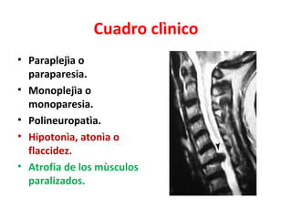 Cuadro clìnico
• Paraplejìa o
  paraparesia.
• Monoplejìa o
  monoparesia.
• Polineuropatìa.
• Hipotonìa, atonìa o
  flaccidez.
• Atrofia de los mùsculos
  paralizados.
 