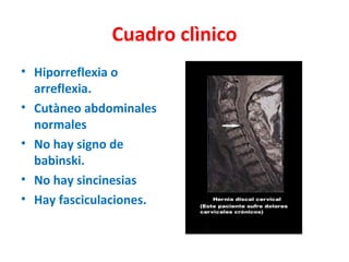 Cuadro clìnico
• Hiporreflexia o
  arreflexia.
• Cutàneo abdominales
  normales
• No hay signo de
  babinski.
• No hay sincinesias
• Hay fasciculaciones.
 