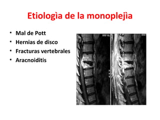 Etiologìa de la monoplejìa
•   Mal de Pott
•   Hernias de disco
•   Fracturas vertebrales
•   Aracnoiditis
 