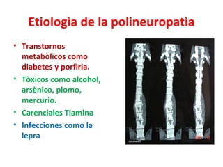 Etiologìa de la polineuropatìa
• Transtornos
  metabòlicos como
  diabetes y porfiria.
• Tòxicos como alcohol,
  arsènico, plomo,
  mercurio.
• Carenciales Tiamina
• Infecciones como la
  lepra
 