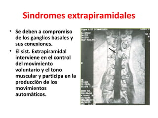 Sìndromes extrapiramidales
• Se deben a compromiso
  de los ganglios basales y
  sus conexiones.
• El sist. Extrapiramidal
  interviene en el control
  del movimiento
  voluntario y el tono
  muscular y participa en la
  producciòn de los
  movimientos
  automàticos.
 