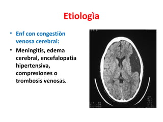Etiologìa
• Enf con congestiòn
  venosa cerebral:
• Meningitis, edema
  cerebral, encefalopatìa
  hipertensiva,
  compresiones o
  trombosis venosas.
 
