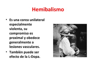 Hemibalismo
• Es una corea unilateral
  especialmente
  violenta, su
  compromiso es
  proximal y obedece
  generalmente a
  lesiones vasculares.
• Tambièn puede ser
  efecto de la L-Dopa.
 