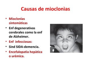 Causas de mioclonìas
• Mioclonìas
  sintomàticas
• Enf degenerativas
  cerebrales como la enf
  de Alzheimer.
• Enf infecciosas:
• Sind SIDA-demencia.
• Encefalopatìa hepàtica
  o urèmica.
 