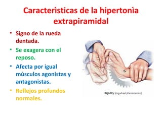 Caracterìsticas de la hipertonìa
            extrapiramidal
• Signo de la rueda
  dentada.
• Se exagera con el
  reposo.
• Afecta por igual
  mùsculos agonistas y
  antagonistas.
• Reflejos profundos
  normales.
 