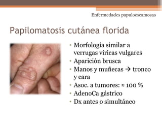 Papilomatosis cutánea florida
• Morfología similar a
verrugas víricas vulgares
• Aparición brusca
• Manos y muñecas  tronco
y cara
• Asoc. a tumores: ≈ 100 %
• AdenoCa gástrico
• Dx antes o simultáneo
Enfermedades papuloescamosas
 