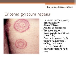 Eritema gyratum repens
• Lesiones eritematosas,
pruriginosas y
descamativas
• Anillos concéntricos
• Tronco y región
proximal de miembros
(1 cm/día)
• Asoc. a tumores: 82 %
• Tumor de pulmón >
esófago > mama
• Dx 1-2 años antes
• Exéresis tumoral  6
sem
Enfermedades eritematosas
 